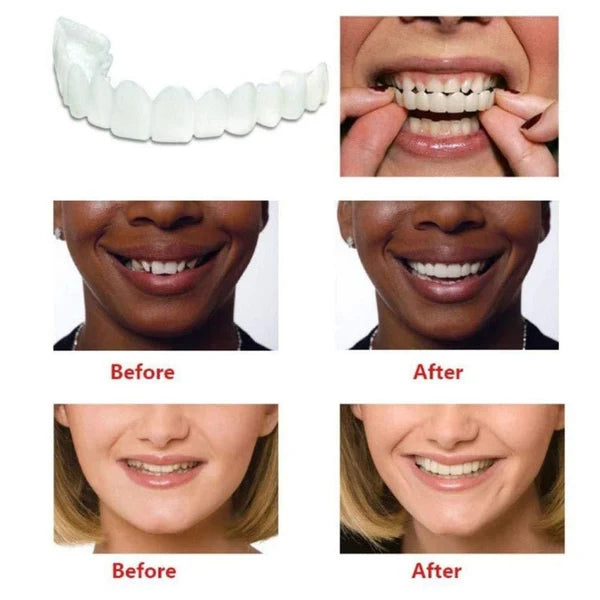 Snap-On Smile Teeth Cover – Natural Looking Cosmetic Veneers | Instant Perfect Smile Veneers – Upper & Lower Teeth Set